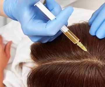 Hair Mesotherapy