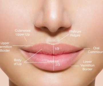 Lip Lift