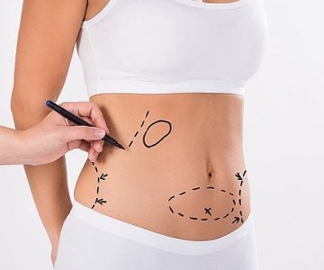 Liposuction