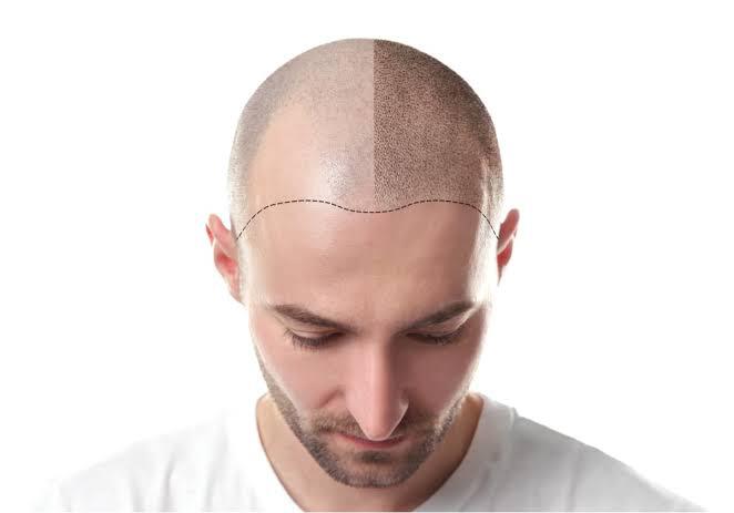 Hair Transplant